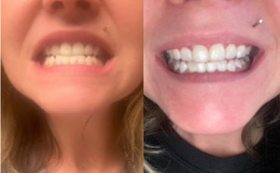 Crest Whitening Emulsions Before After 1
